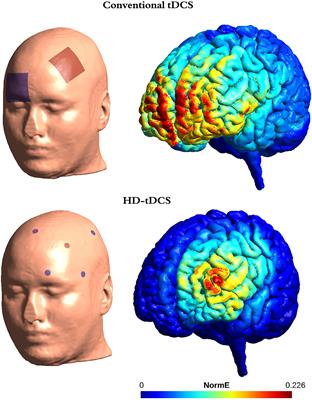 Therapeutic Use of Transcranial Direct Current Stimulation in the Rehabilitation of Prolonged Disorders of Consciousness